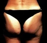 endermologia po