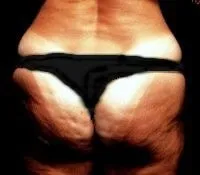 endermologia przed