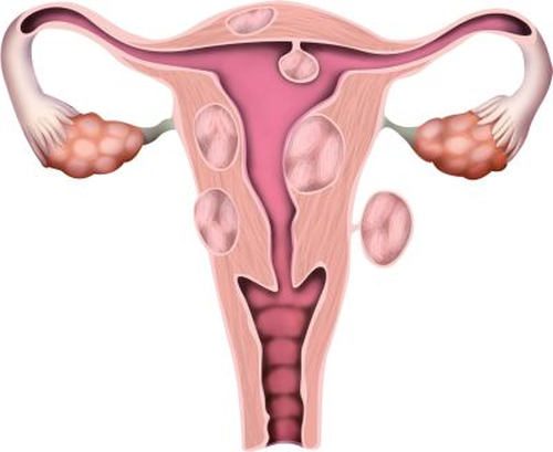 Mięśniaki macicy w ciąży 