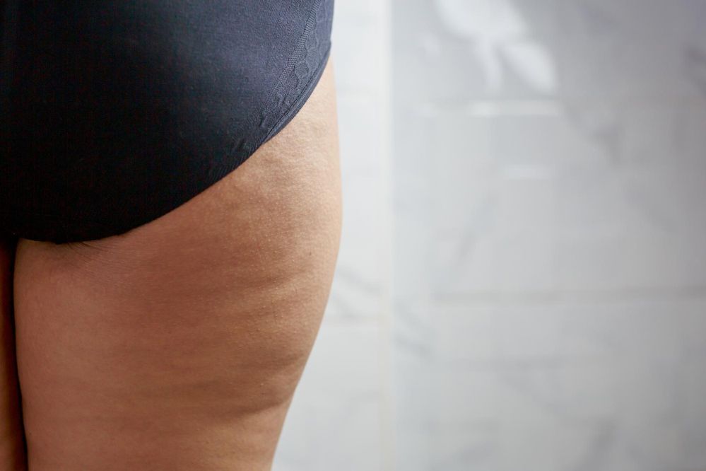 Lipedema – „choroba grubych nóg”, o której wciąż mówi się zbyt mało